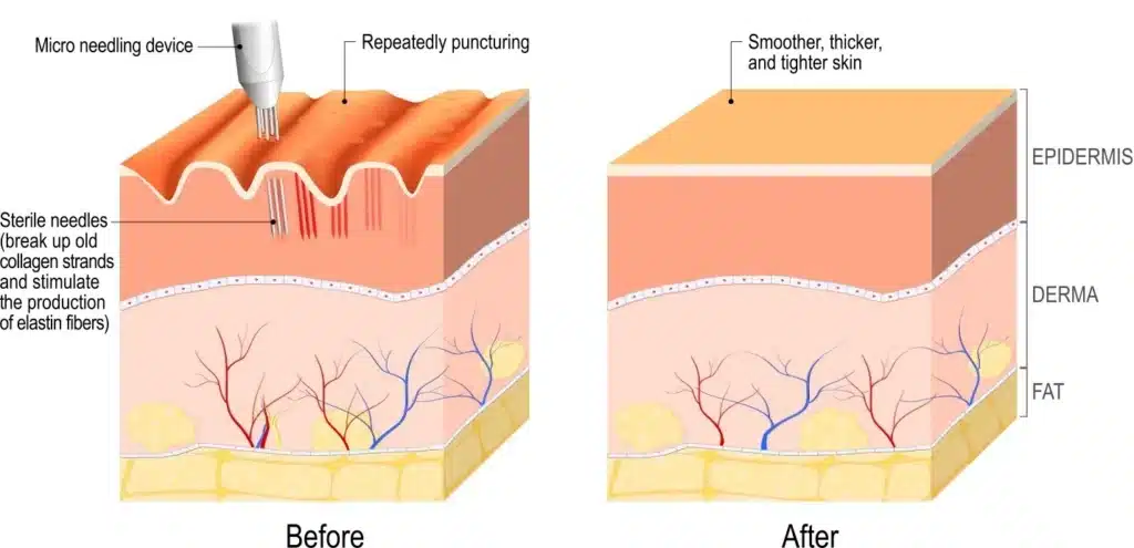 what is microneedling?