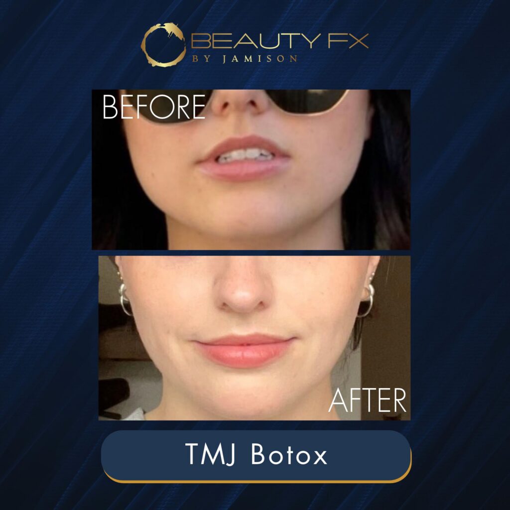 TMJ Botox in Los Angeles