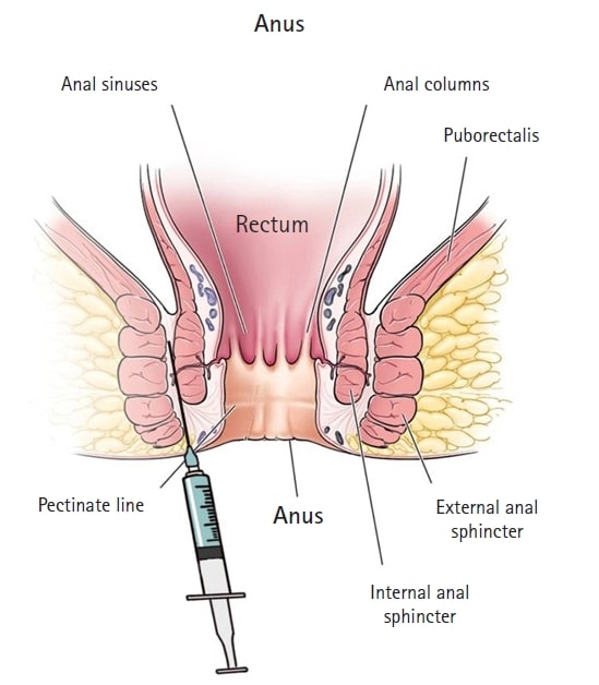 what is anal botox?