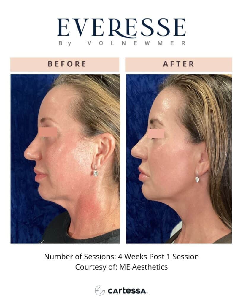 skin tightening in los angeles
